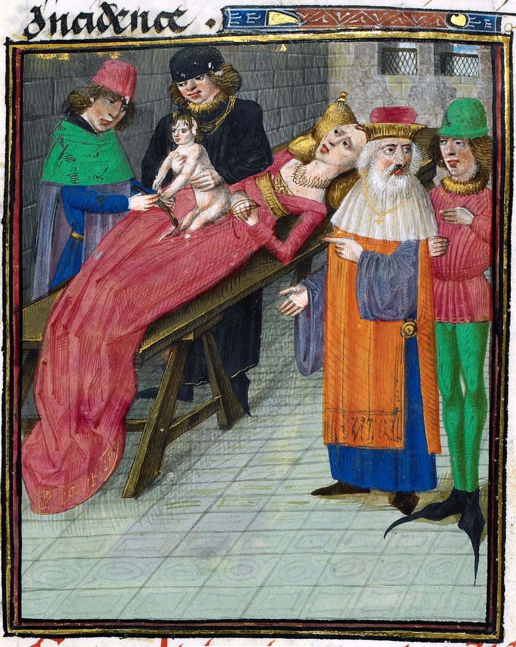 Medieval Depiction of Caesarian Birth by Unbekannt Unbekannt