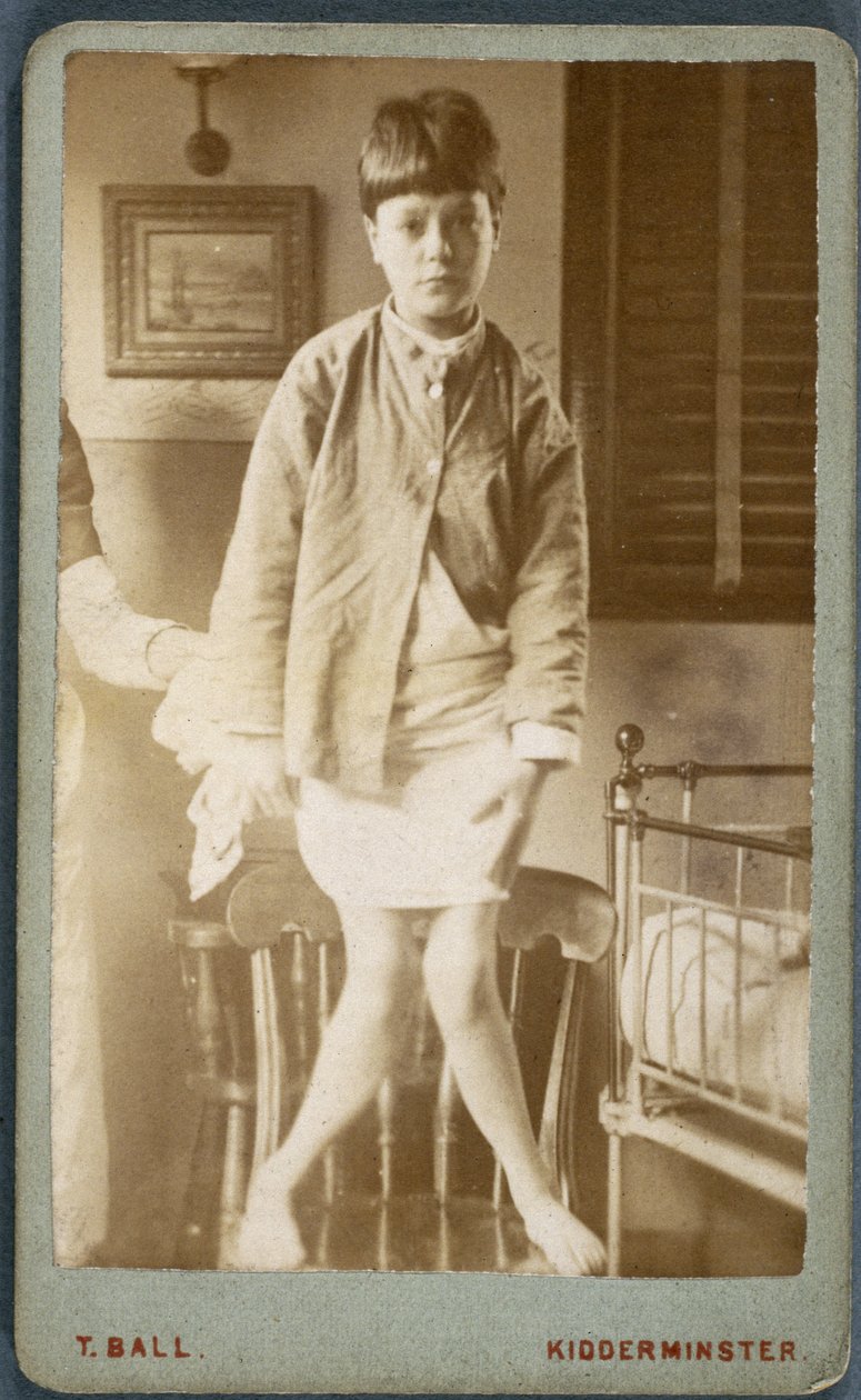 Diseases, Rickets Child with rickets by Unbekannt