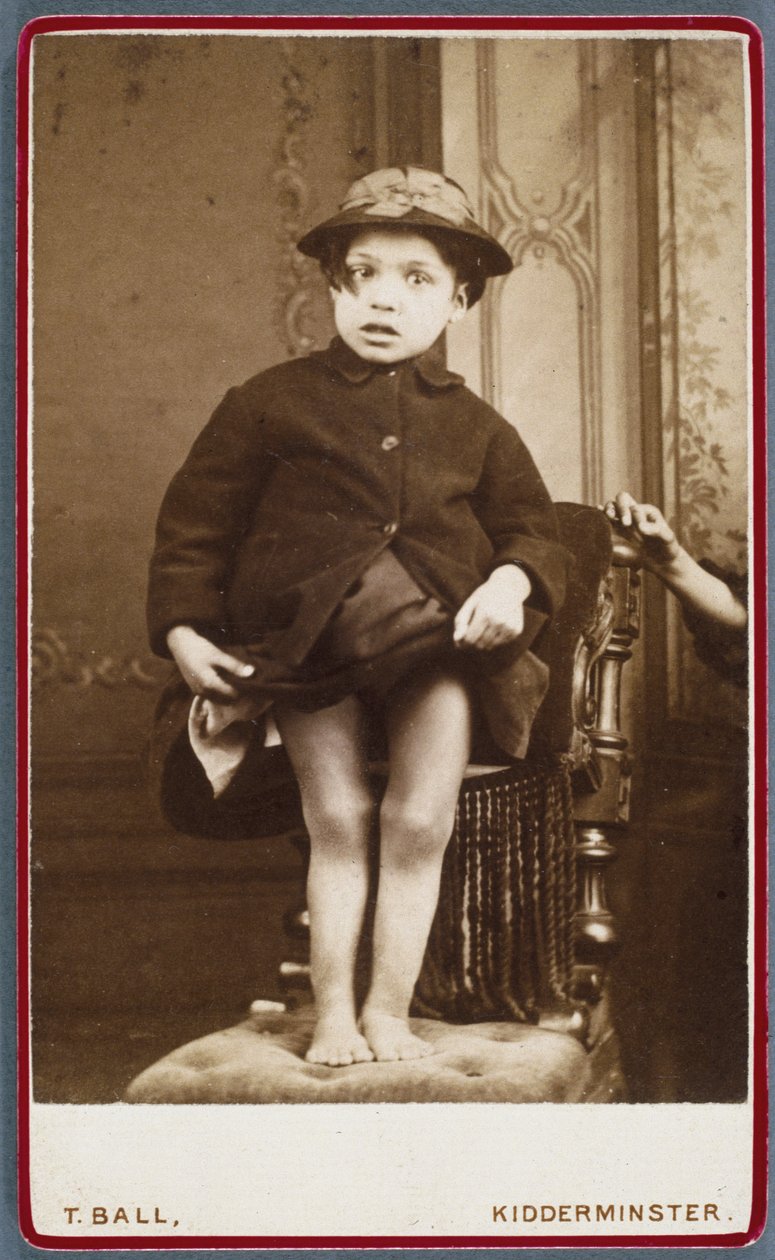 Diseases, Rickets Child with rickets by Unbekannt