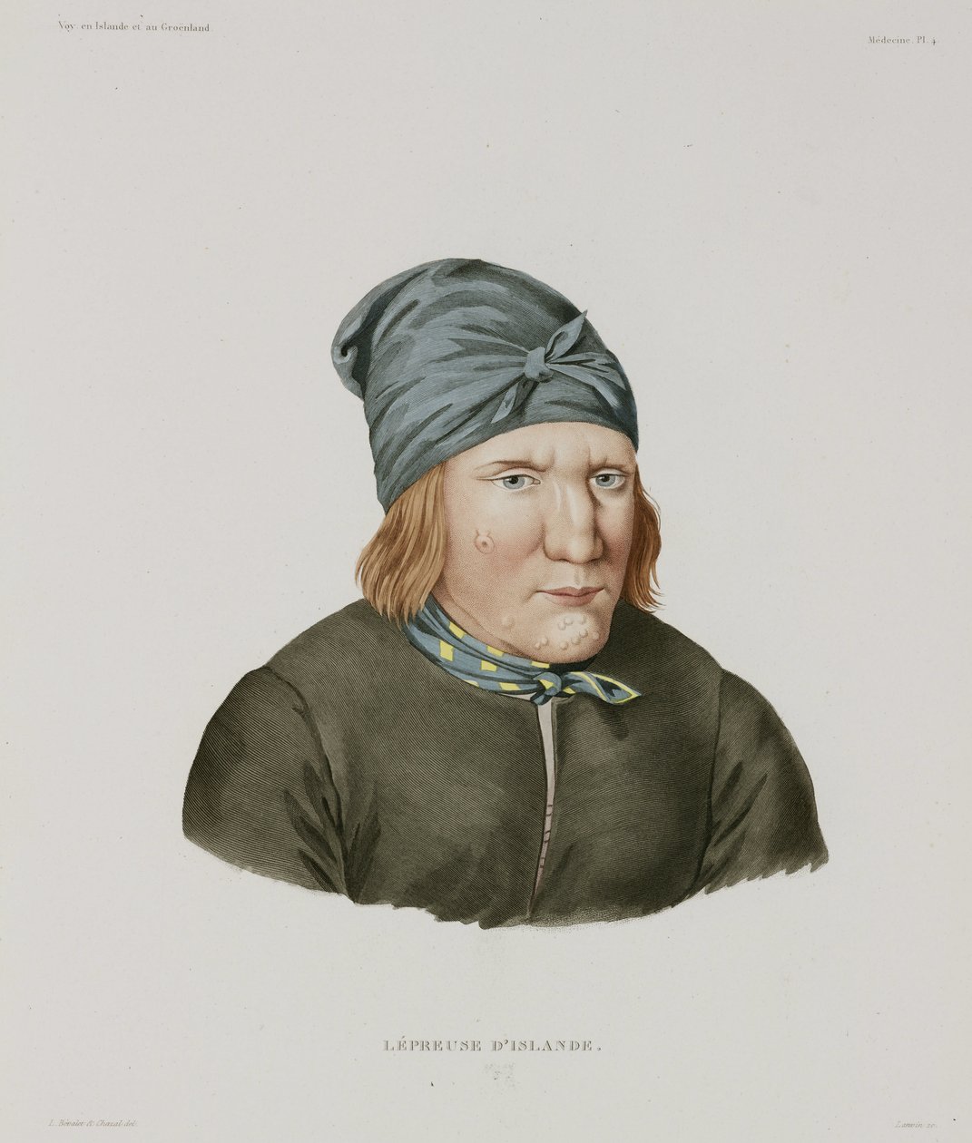 Diseases, Leprosy (Female Leper, Iceland, Early 19th Century) by Unbekannt