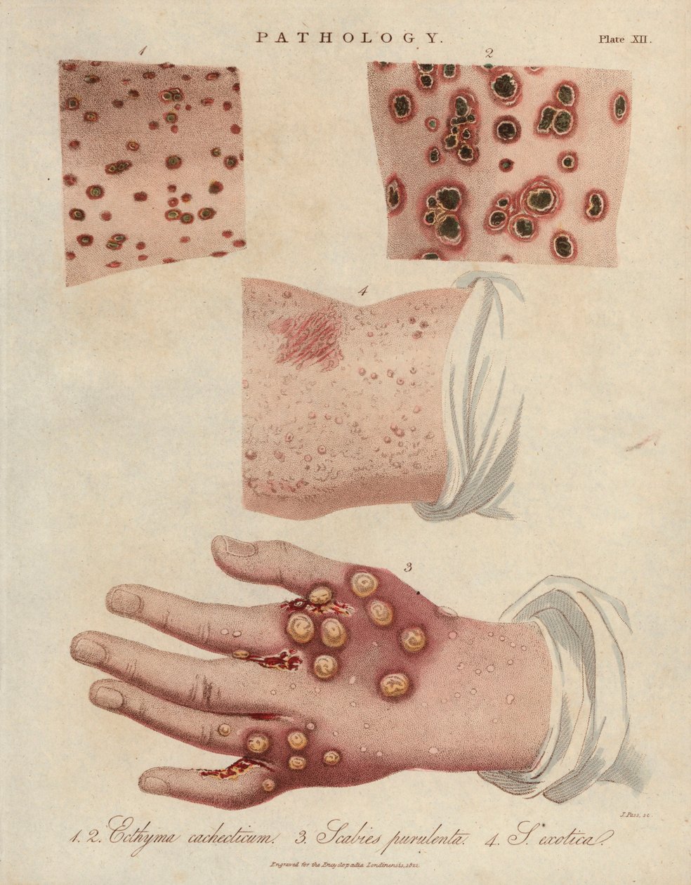 Skin Ulcer and Scabies by Unbekannter Künstler