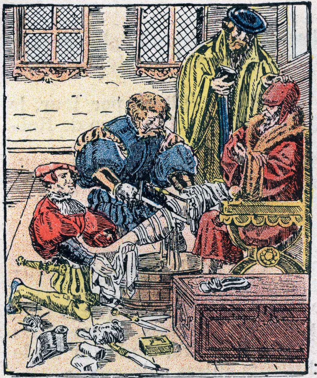 Amputation of a leg in the 16th century. by Unknown artist