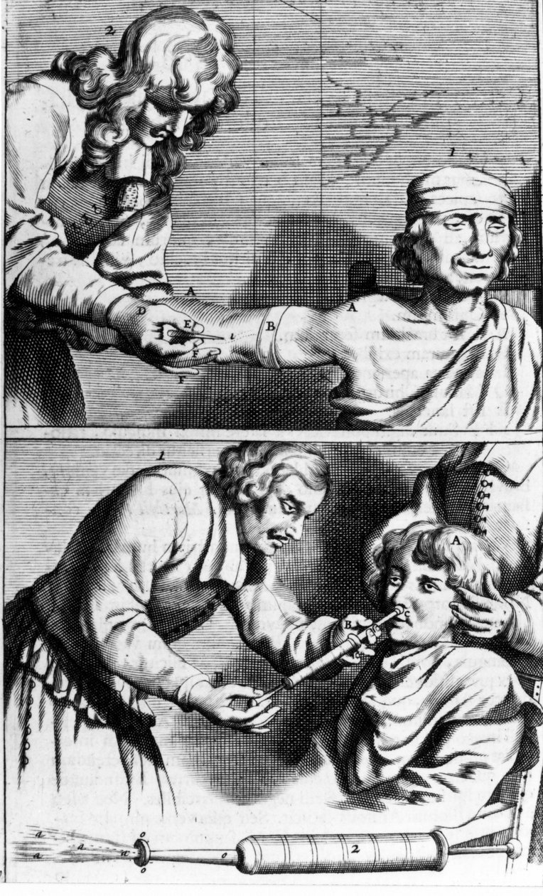 Bleeding and nasal shower by Johannes Sculpteti "Armamentarium Surgery" Amsterdam 1672 by Unknown artist