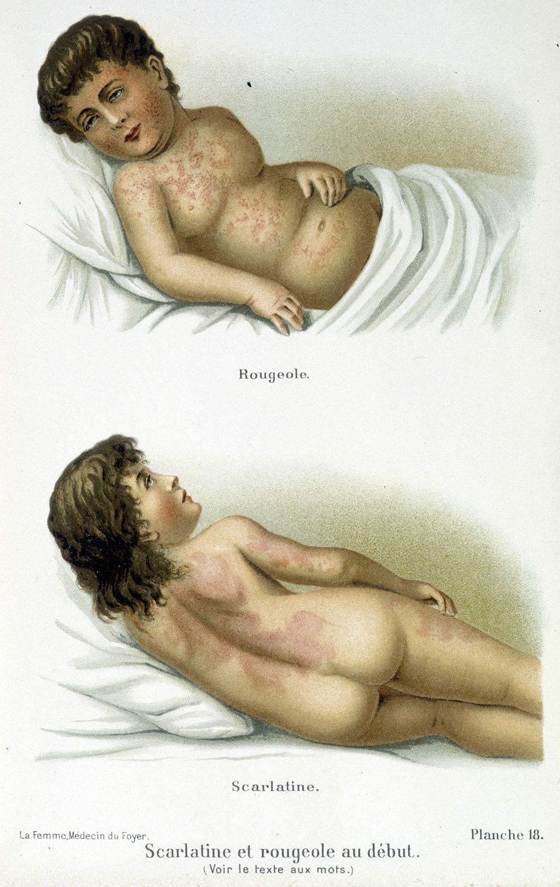 Scarlet Fever and Measles - 19th Century by Unknown artist