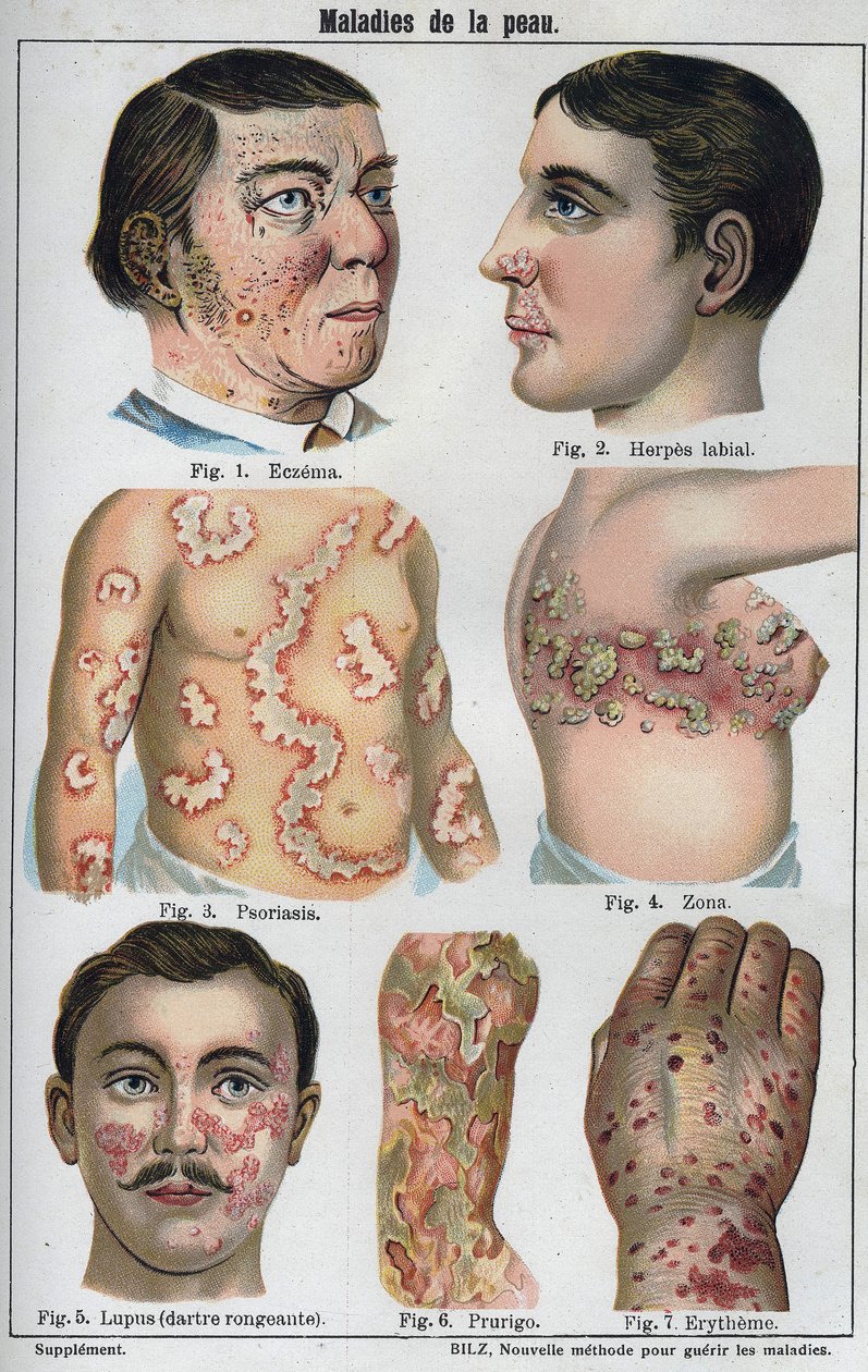 Skin diseases: Eczema, labial herpes, psoriasis, shingles, lapus (rotting darter), prurigo, erytheme. 