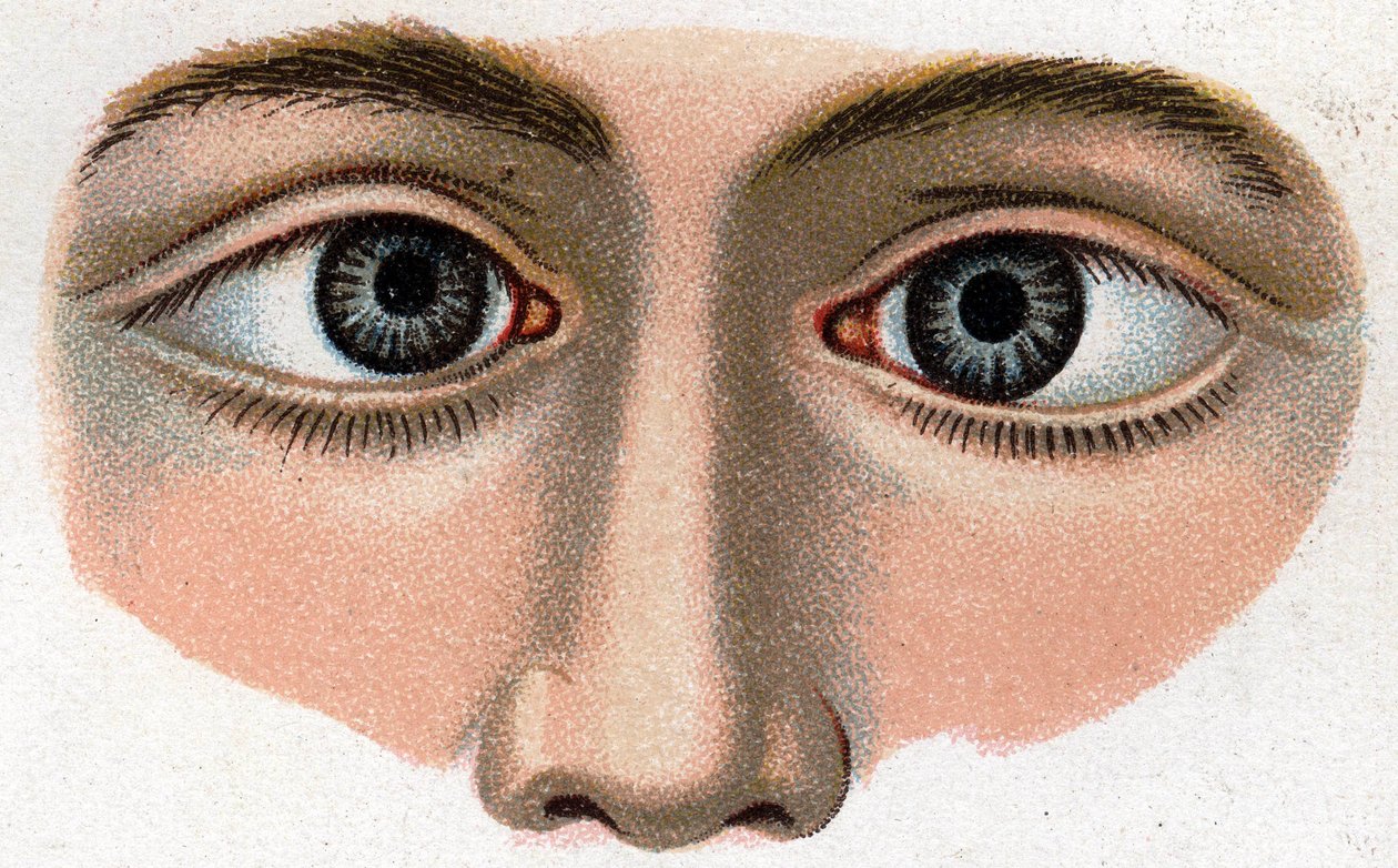Strabismus converge. 