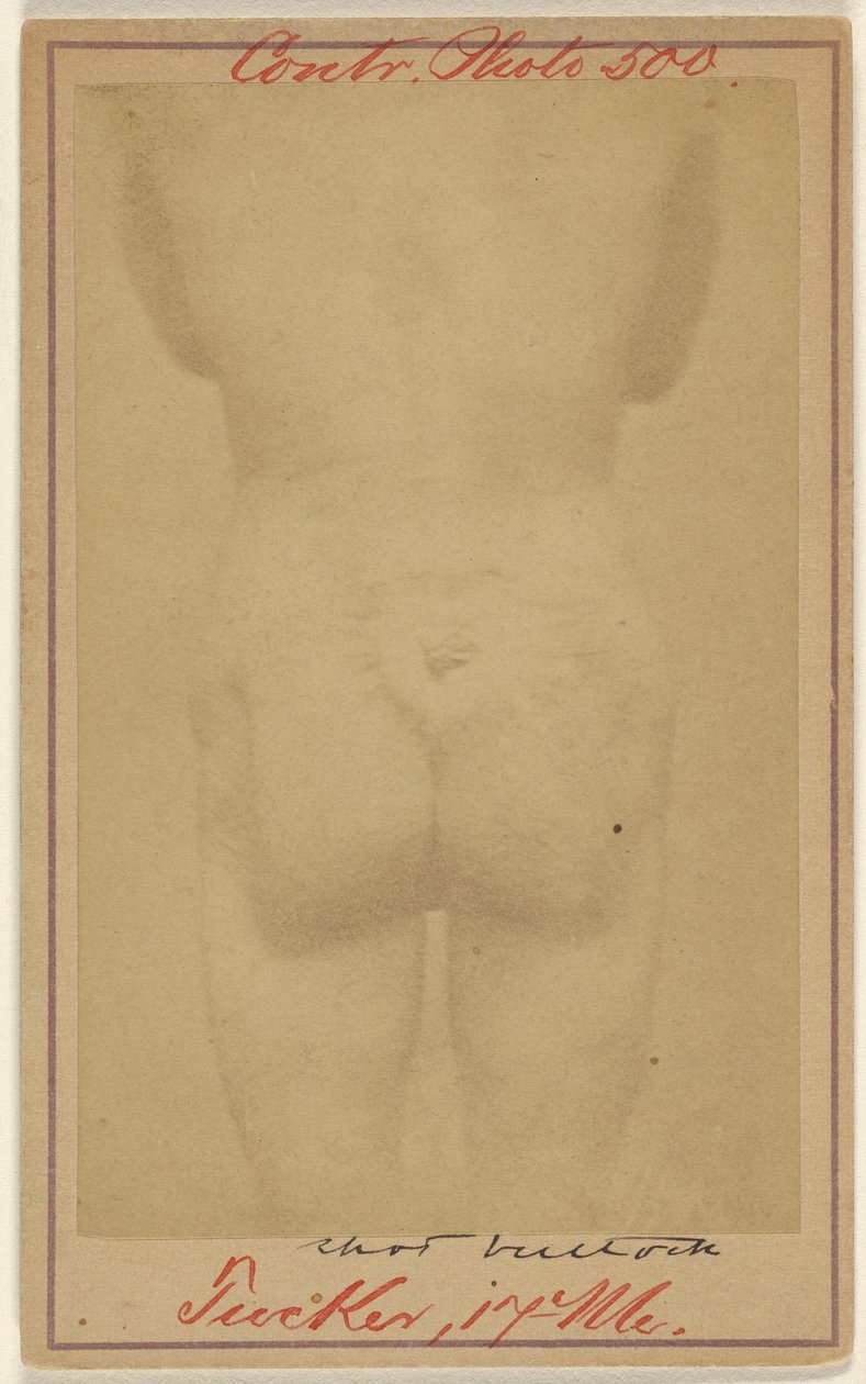 Jno. E. Tucker, Shot in the Buttocks, Civil War Victim by Unknown artist