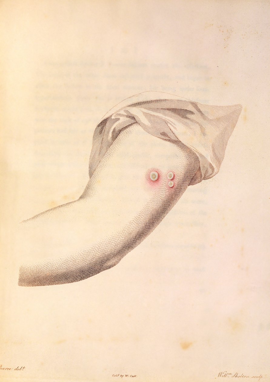 Arm of William Pead Used for Smallpox Vaccine, from 'An Inquiry into ...