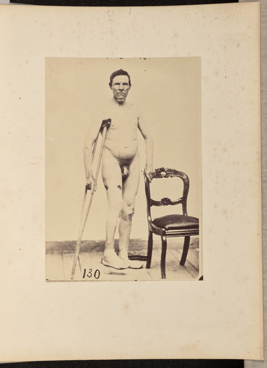 Consolidated Gunshot Fracture of the Middle Third of the Right Femur by William H. Bell