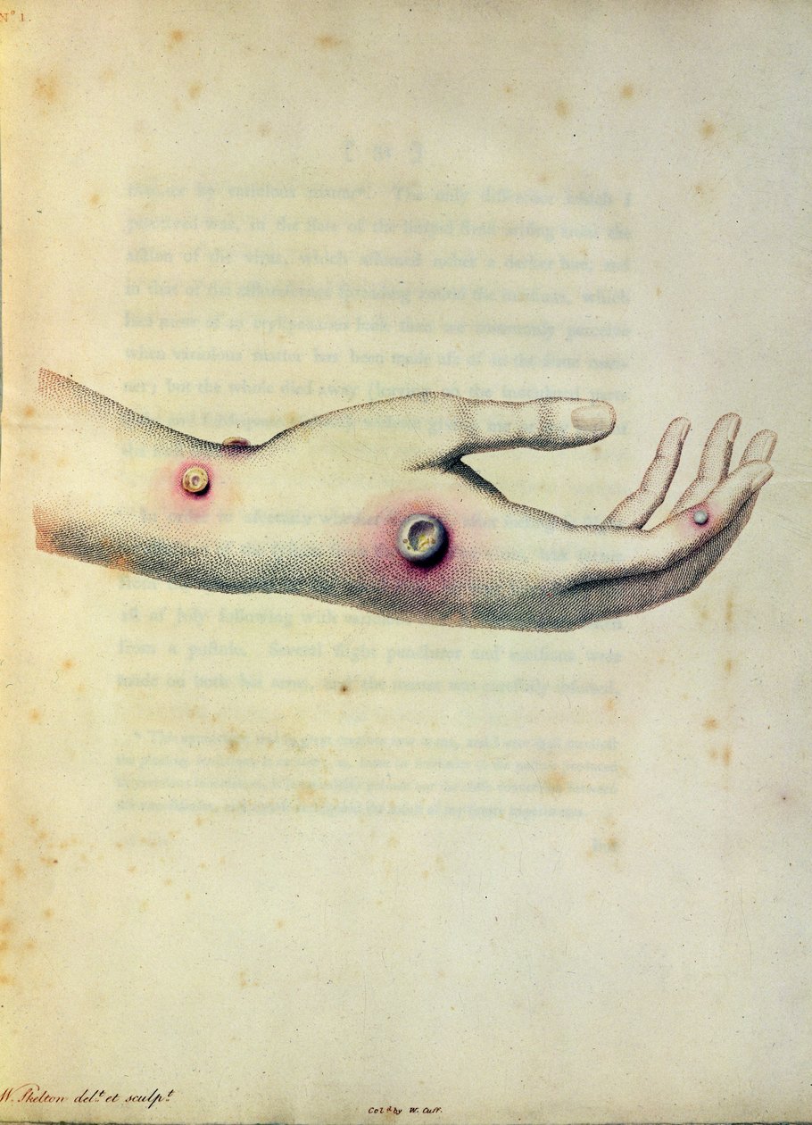 Cowpox pustule on the arm of Sarah Nelmes, from 