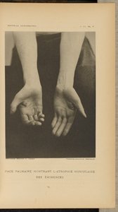Palmar Face Showing Muscular Atrophy of the Eminences by Albert Londe