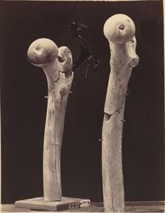 Specimens of Gunshot Fractures of the Femur