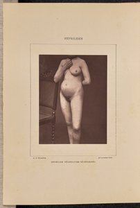 Generalized Vesicular Syphilis