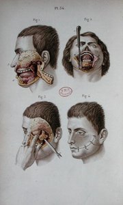 Anatomical plate of the upper jaw