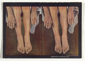Exfoliative Dermatitis by Dr. Selden I. Rainforth