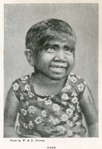 Krao, The Missing Link, Exhibited at the Aquarium, Westminster, London, in 1887 by English Photographer