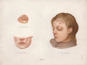 Diseases of the Skin: Herpes by English School