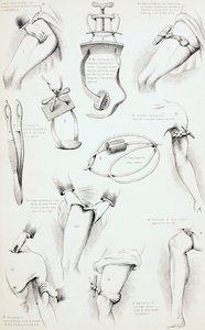 Methods of Arresting Bleeding