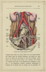 Lateral Deviation of the Uterus Preventing Fertilization