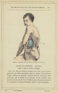 Characteristic Swelling of the Spleen During a Malarial Fever