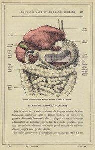 Characteristic Lesions of Ulcerative Gastritis, Stomach Ulcer