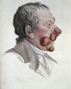 Mycosis Fongoide, from a book by Baron Jean Louis Alibert by French School