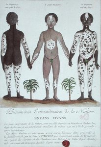 The Phenomenon of Leukoderma
