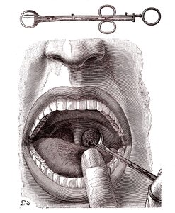 Tonsillectomy by French School