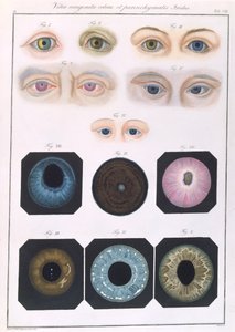 Description of congenital eye anomalies, from Klinische Darstellungen der Krankheiten und Blidungsfehler des Menschlichen Auges, by Friedrich August von Ammon, 1838