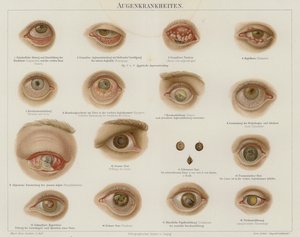 Eye disorders