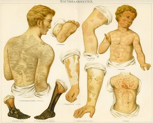 Skin Disorders, c.1890 by German School