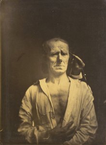 Spasm of m. corrugator supercilii under very strong light (left); A relaxed face (photographed in full sunshine) (right) by Guillaume Benjamin Amant Duchenne