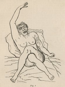 Hysterical Epilepsy, Attack, Contortions, fig. 1 from 