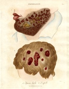 Pathological Illustration of Sycosis barbae and Sycosis capilli