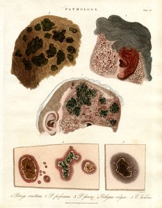 Pathological Skin Changes: Porriga and Ecthyma