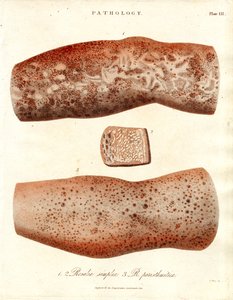 Skin Eruptions - Roseola simplex and Roseola paristhmitica by John Pass