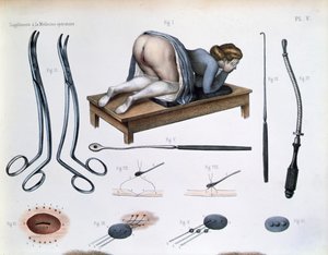 An operation on a vesicovaginal fistula, plate from 