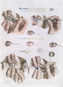 Operation on an Eye, Plate from 