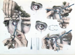 Operation on a strabismus, plate from 