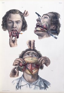 Operation on the lower jaw, plate from 