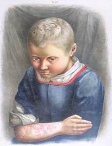 Favus, from a Book by Daniel Cornelius Danielssen, 1892 by Norwegian School