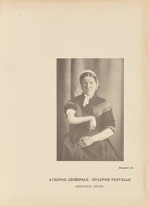 Cerebral Atrophy: Partial Epilepsy Right Hemiplegia by Paul Marie Léon Regnard
