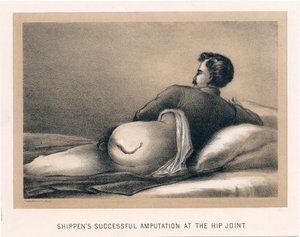 Shippens Successful Amputation at the Hip Joint, American Civil War, 1865