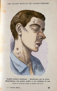 Symptoms of the Tertiary Phase of Syphilis, 19th century by Unbekannt