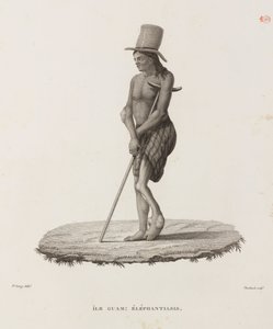 Diseases, Tropical Diseases Man with elephantiasis, Guam