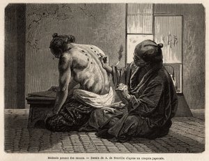 A doctor posing moxas (small sagebrush cones burned in specific parts of the body), a preventive treatment against various symptoms from indigestion to lack of appetite, crying and toothache, employed twice a year and has fixed time by the Japanese. Engrav