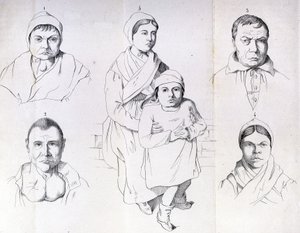Considerations on the causes of endemic cretinism by Morel by Unknown artist