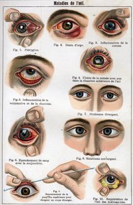 Diseases of the Eye. 