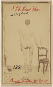 Fracture of the Upper Third of the Femur, Erastus Worthen, Corp Co. B. 2nd Vermont Vols, Aged 25, Residence Stockbridge VT