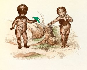 Little Girl Covered with Hairy Spots (engraving) by Unknown artist